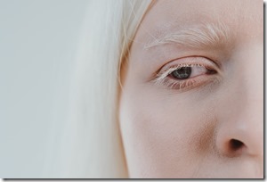 Beauty image of an albino girl posing in studio wearing lingerie. Concept about body positivity, diversity, and fashion