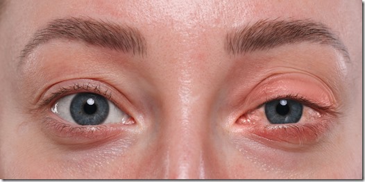 Conjunctivitis. Young woman with bloodshot in eye, closeup