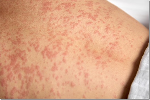  Human skin is covered with painful red spots