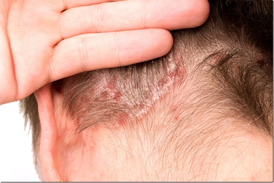 Psoriasis, psoriatic skin disease Psoriasis, psoriatic skin disease