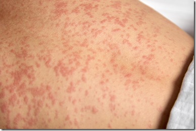 Human skin is covered with painful red spots